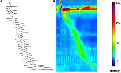 The Potential Benefits of Applying Recent Advances in Esophageal Motility Testing in Patients with Esophageal Atresia